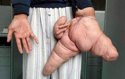 Funny Picture - Hand Tumor To The Extreme